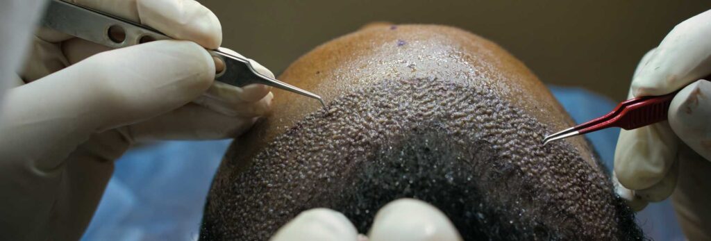 Hair transplant in bangalore