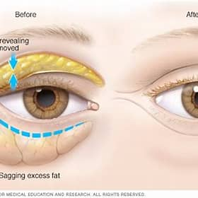 Blepharoplasty eyelid surgery at Karo Clinic Bangalore