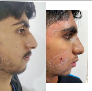 Rhinoplasty at Karo Clinic before and after results