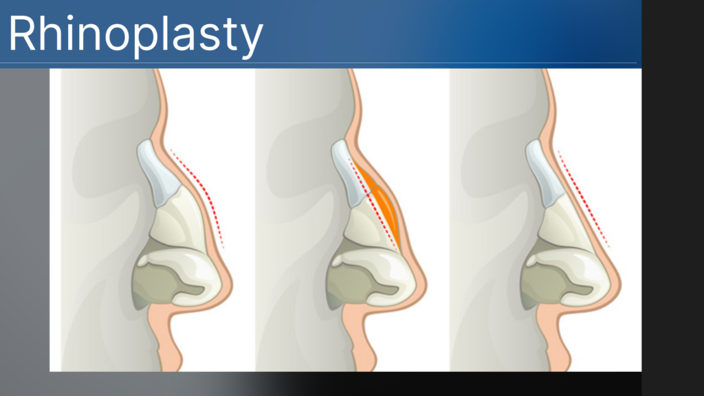 Rhinoplasty Cost in Bangalore